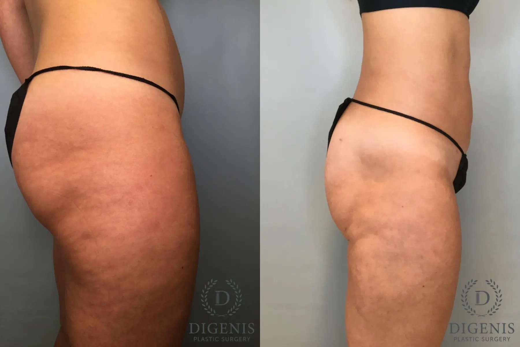 Liposuction: Patient 13 - Before and After 5
