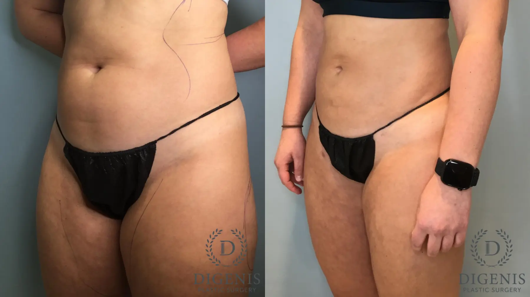 Liposuction: Patient 13 - Before and After 2