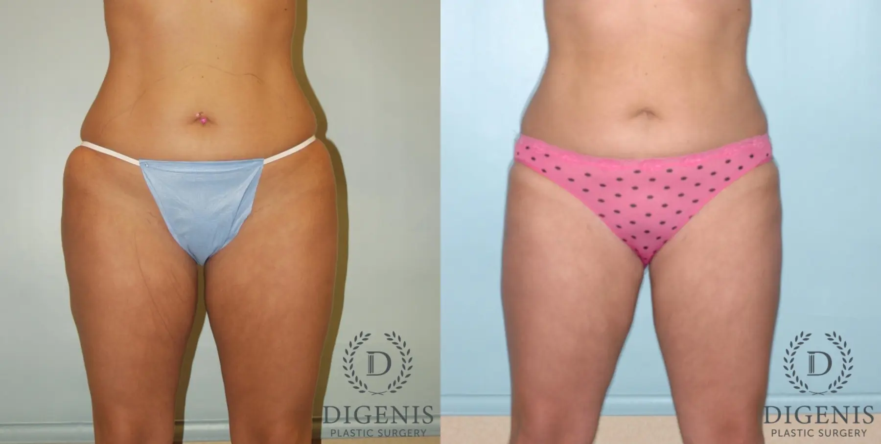 Liposuction: Patient 5 - Before and After 1
