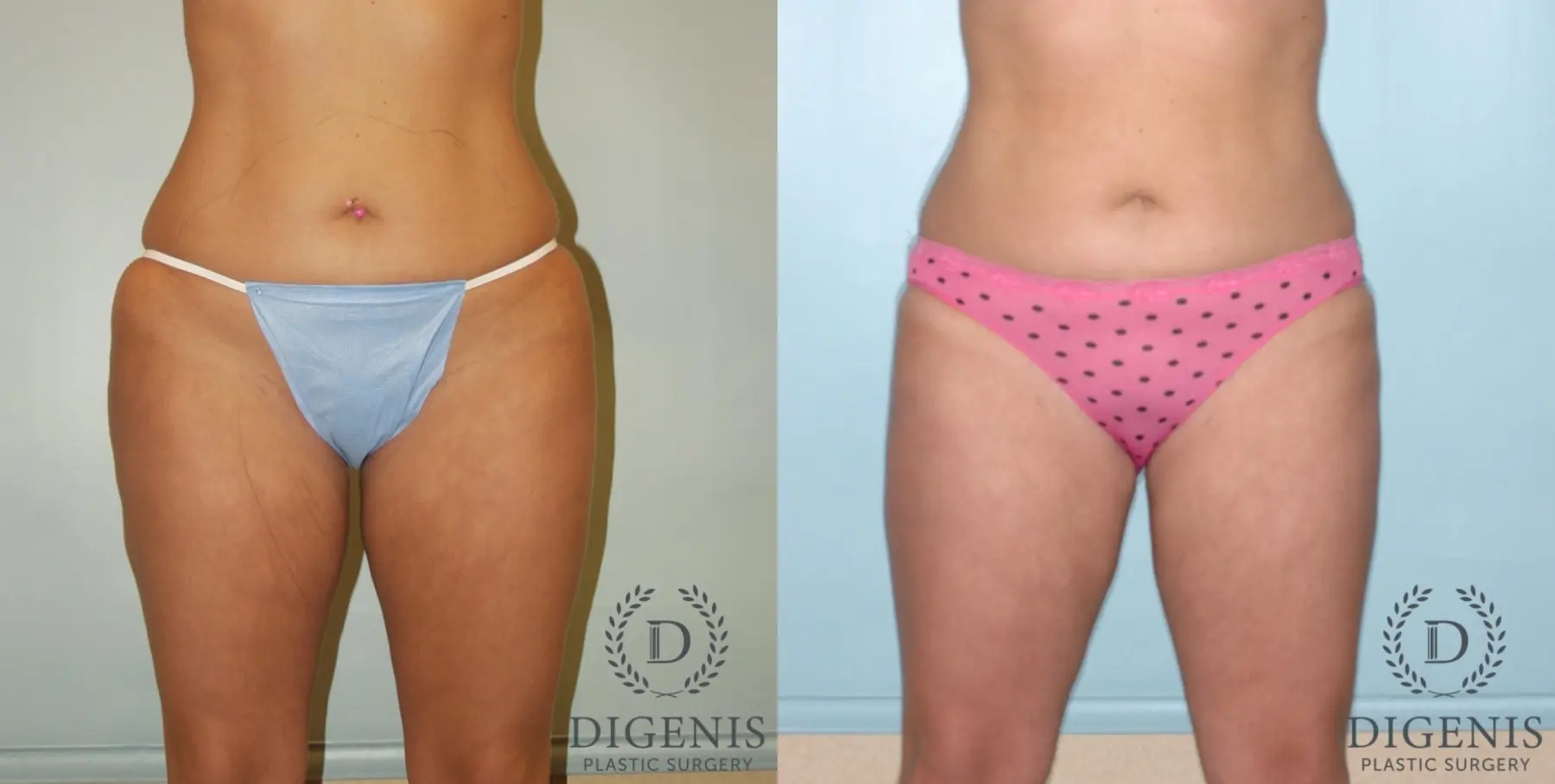 Liposuction: Patient 5 - Before and After  