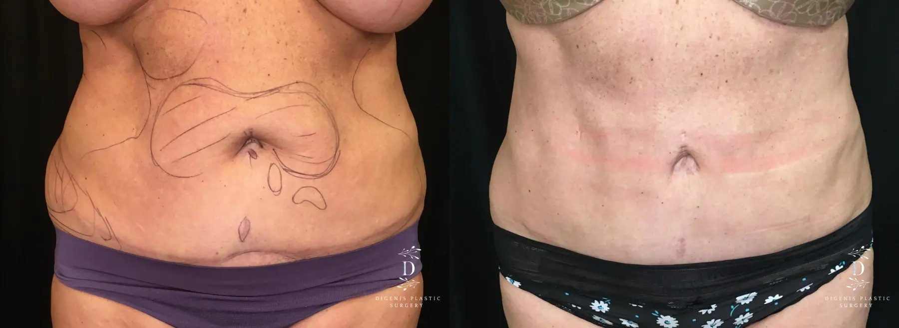 Liposuction: Patient 9 - Before and After  