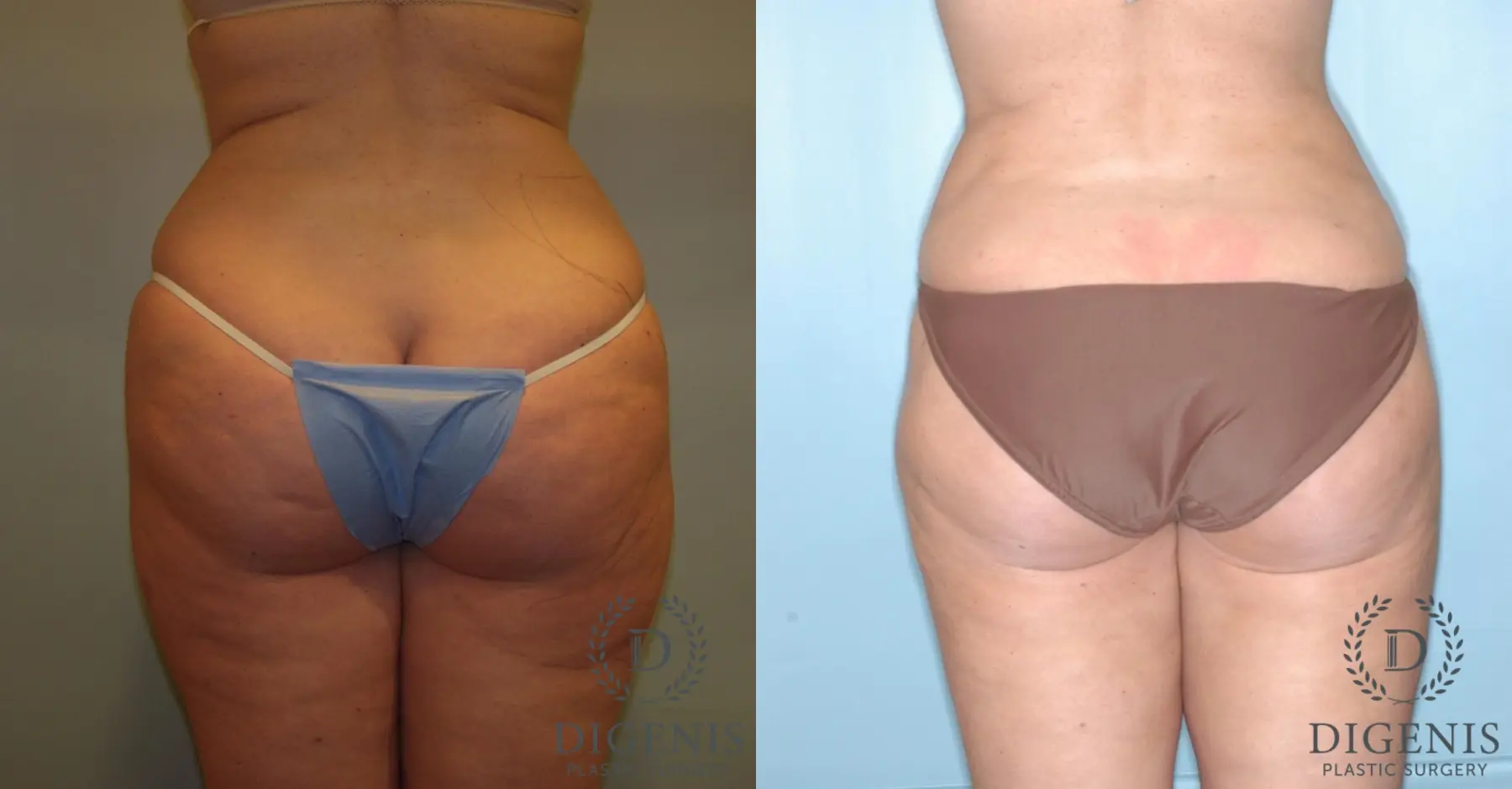 Liposuction: Patient 4 - Before and After 2