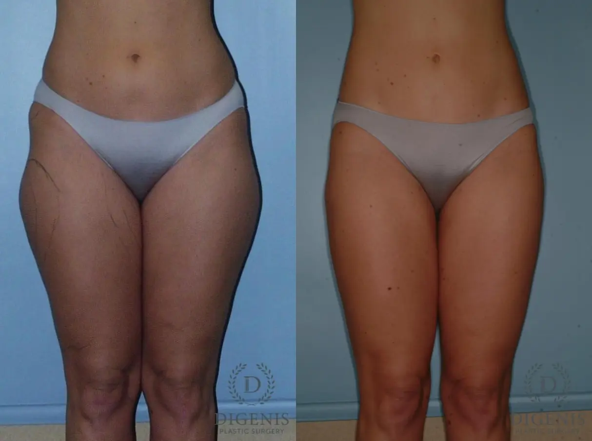 Liposuction: Patient 3 - Before and After 1