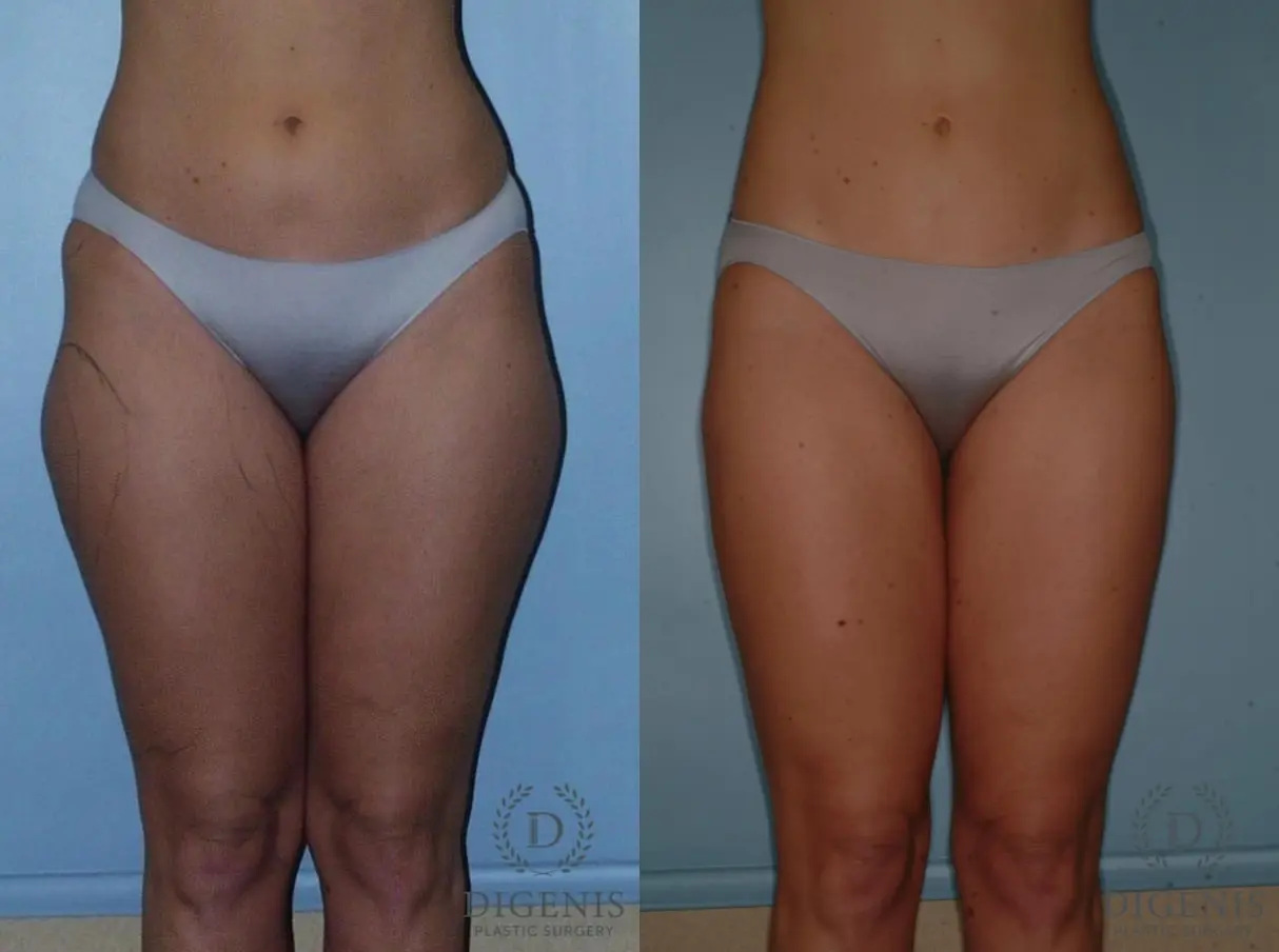 Liposuction: Patient 3 - Before and After  