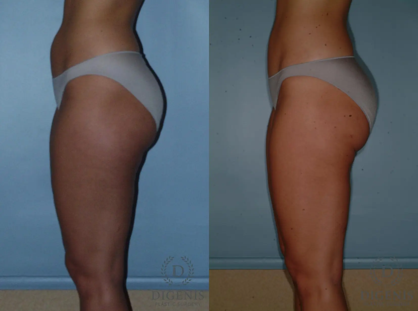 Liposuction: Patient 3 - Before and After 4