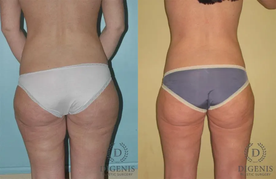 Liposuction: Patient 1 - Before and After 2