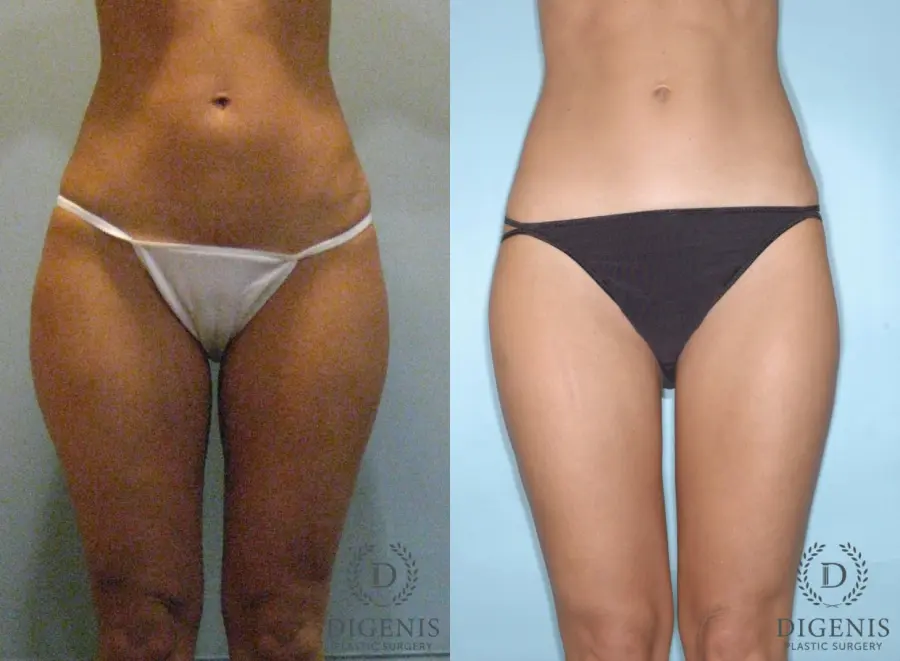 Liposuction: Patient 2 - Before and After  