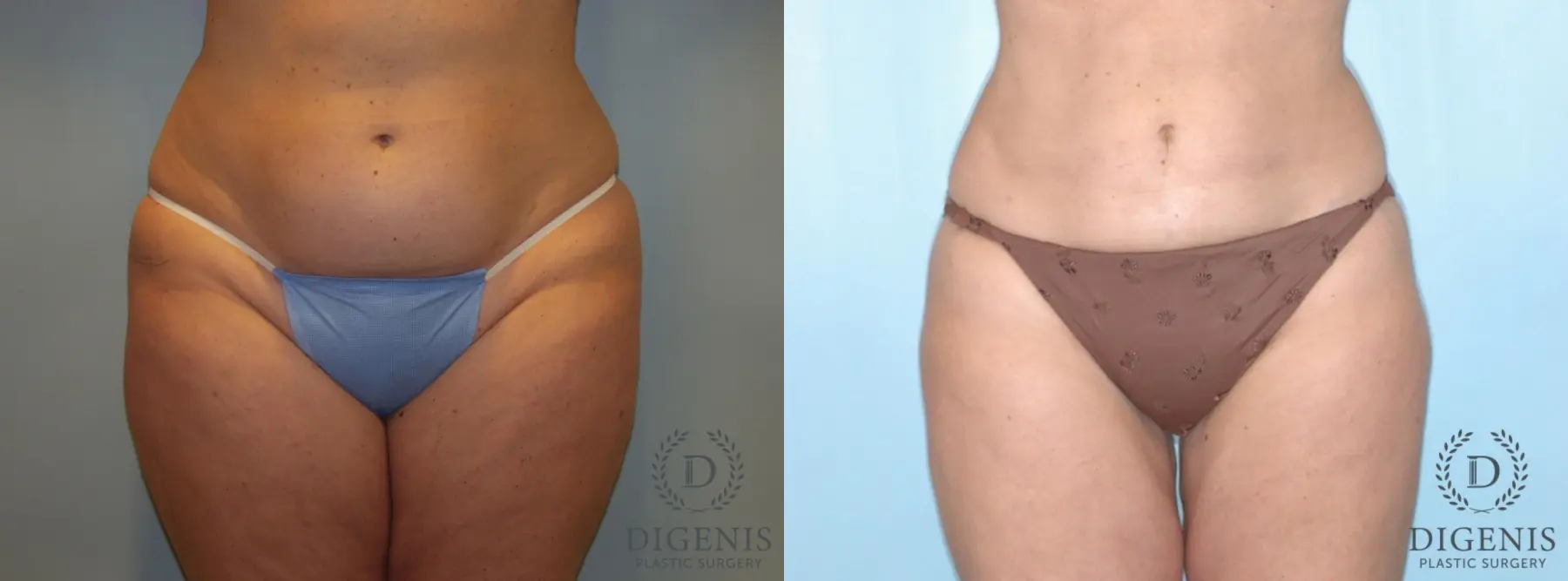 Liposuction: Patient 4 - Before and After  