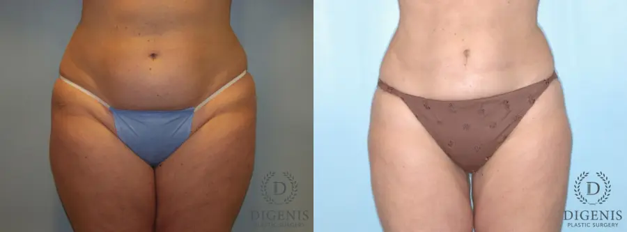 Liposuction: Patient 4 - Before and After 1