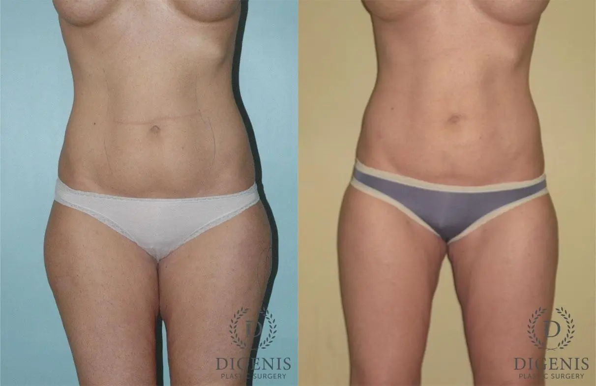 Liposuction: Patient 1 - Before and After 1