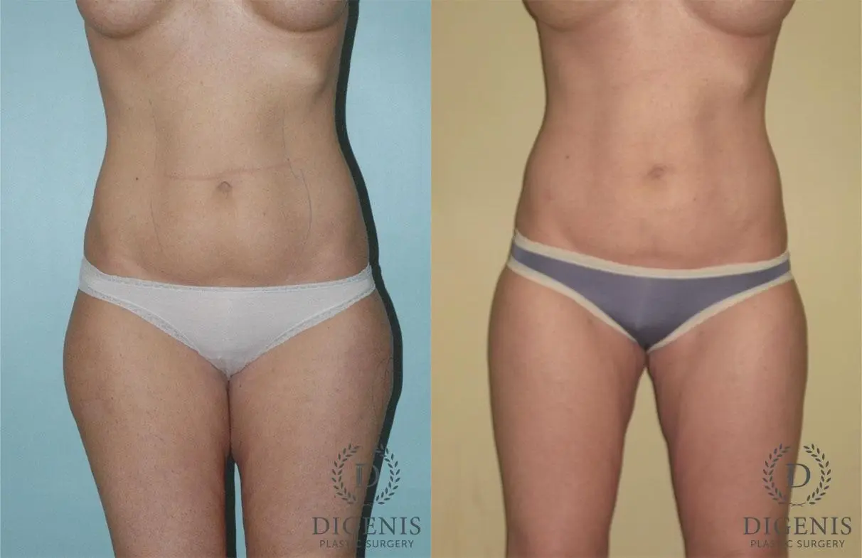 Liposuction: Patient 1 - Before and After  