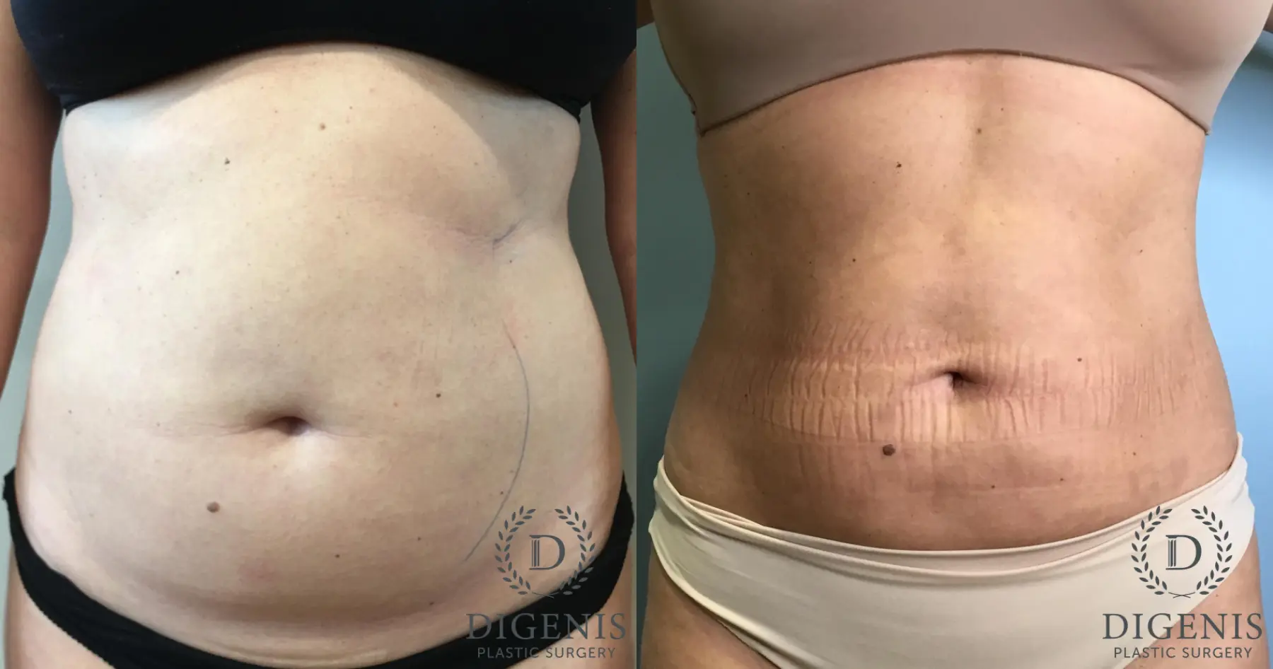 Liposuction: Patient 2 - Before and After  