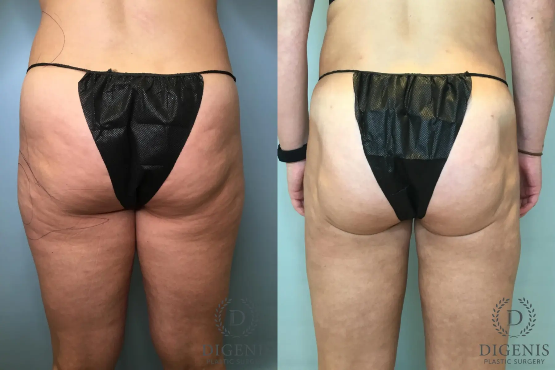 Liposuction: Patient 13 - Before and After 4