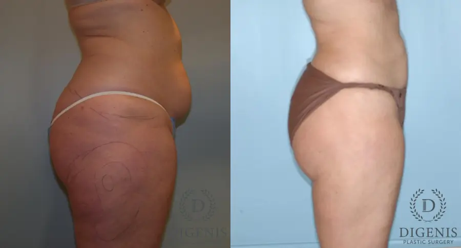 Liposuction: Patient 4 - Before and After 3