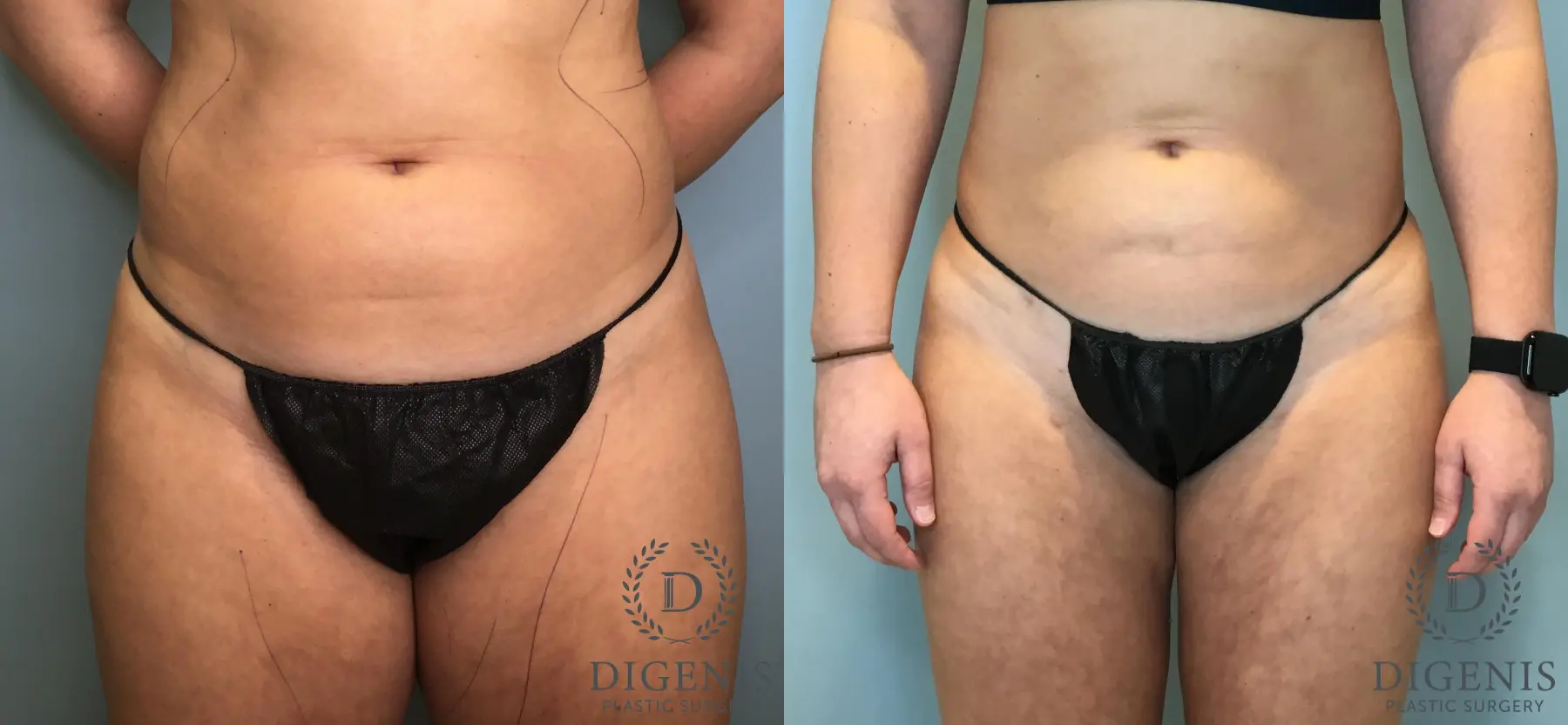 Liposuction: Patient 13 - Before and After 1