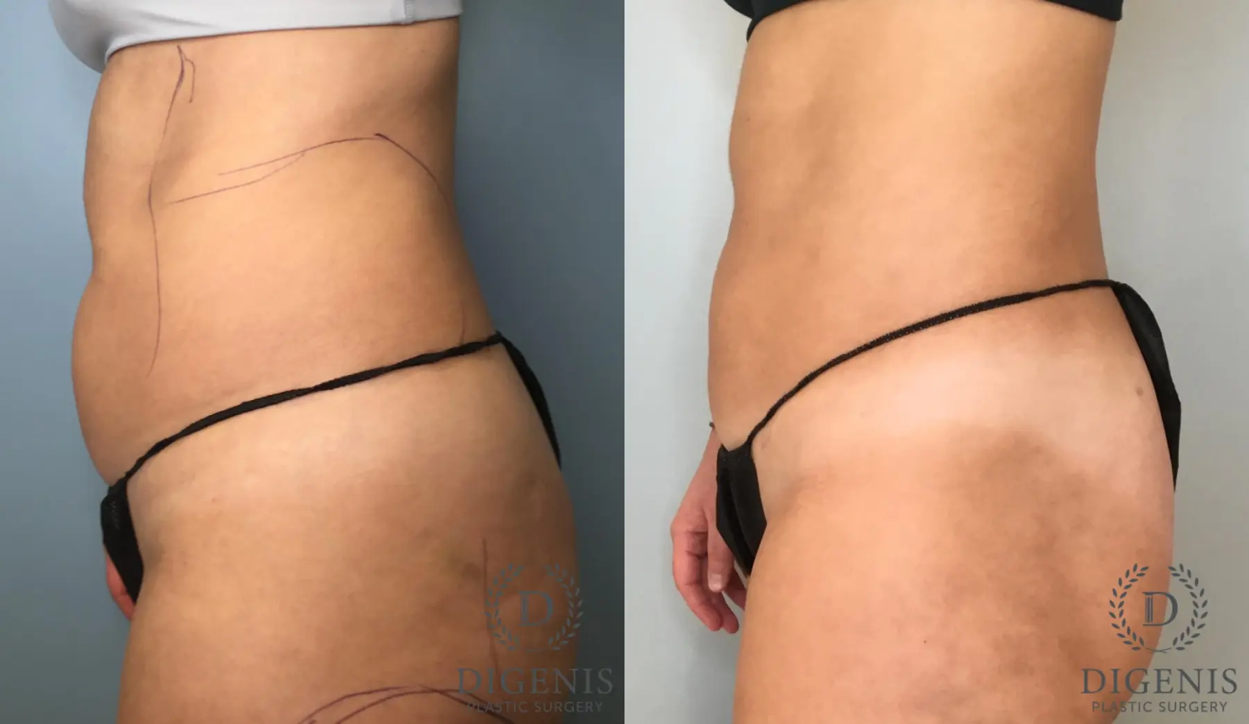 Liposuction: Patient 13 - Before and After 3