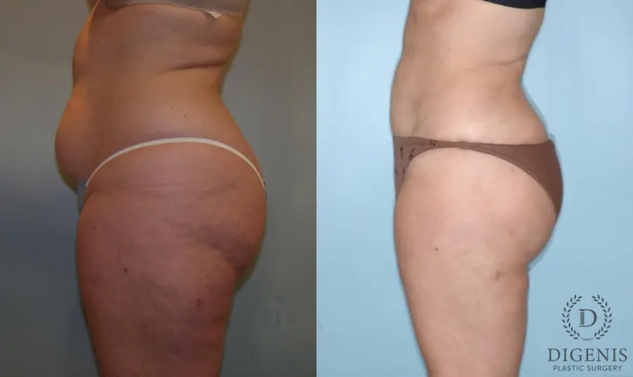 Liposuction: Patient 4 - Before and After 4