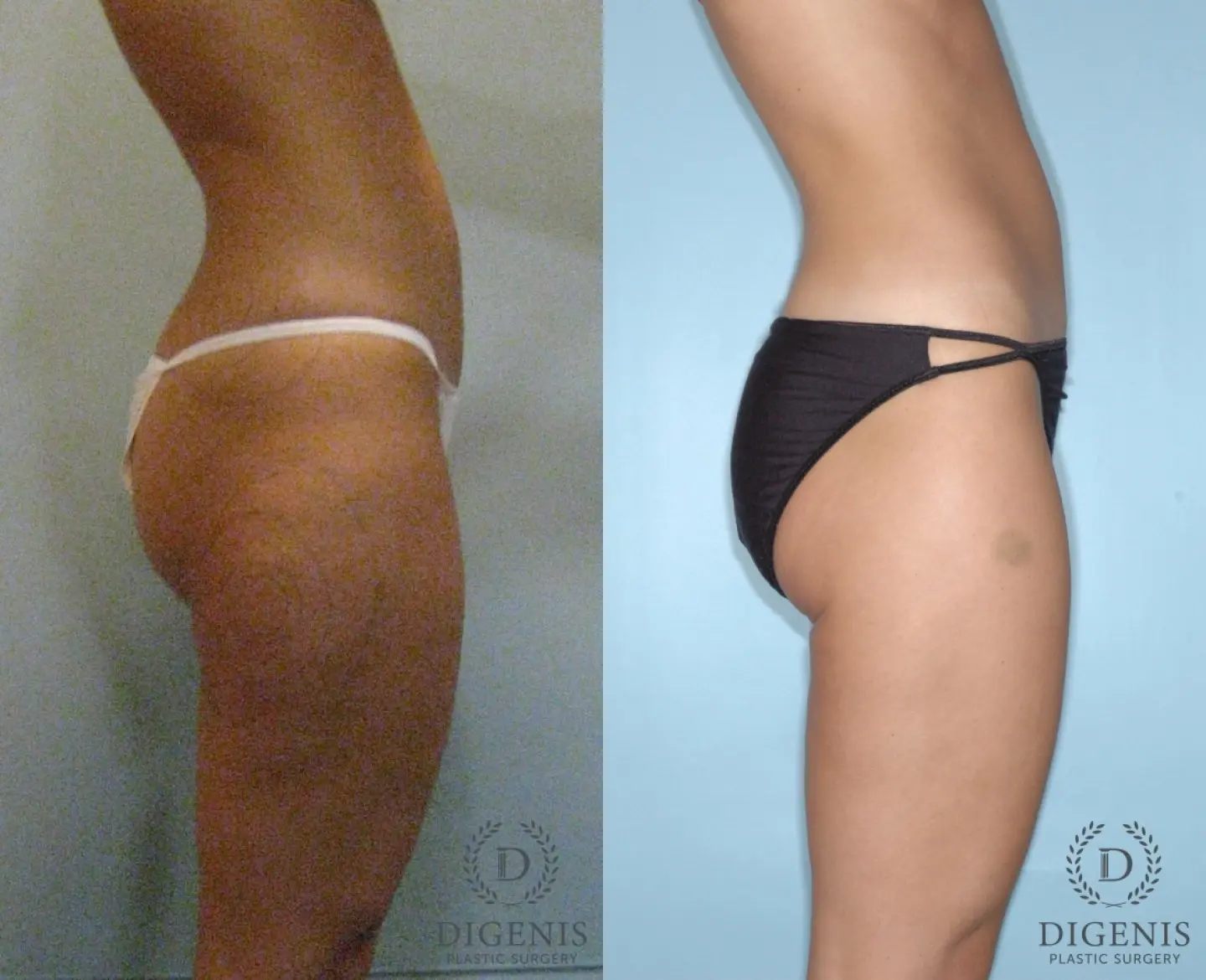Liposuction: Patient 2 - Before and After 3