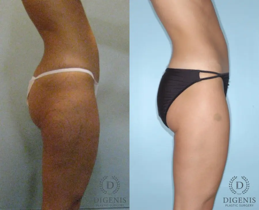 Liposuction: Patient 2 - Before and After 3