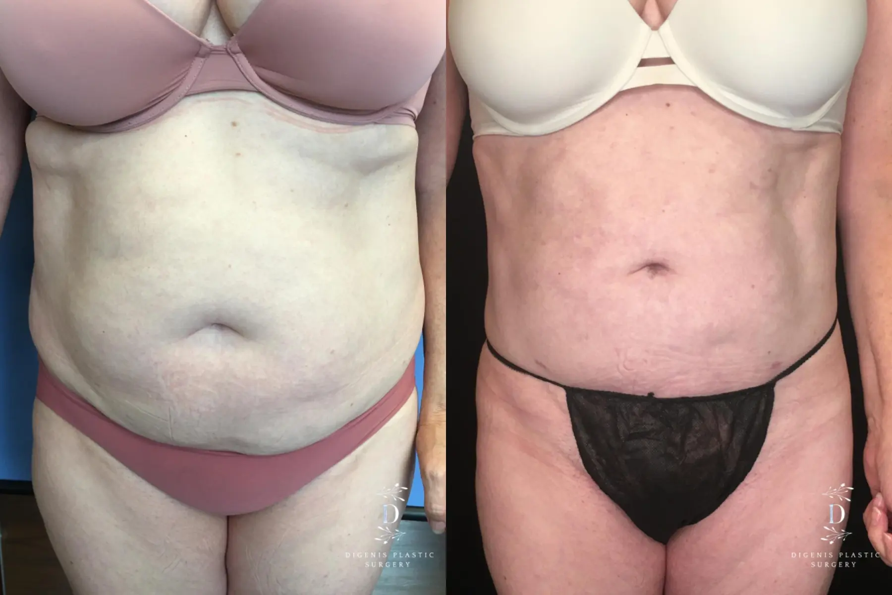 Liposuction: Patient 8 - Before and After  