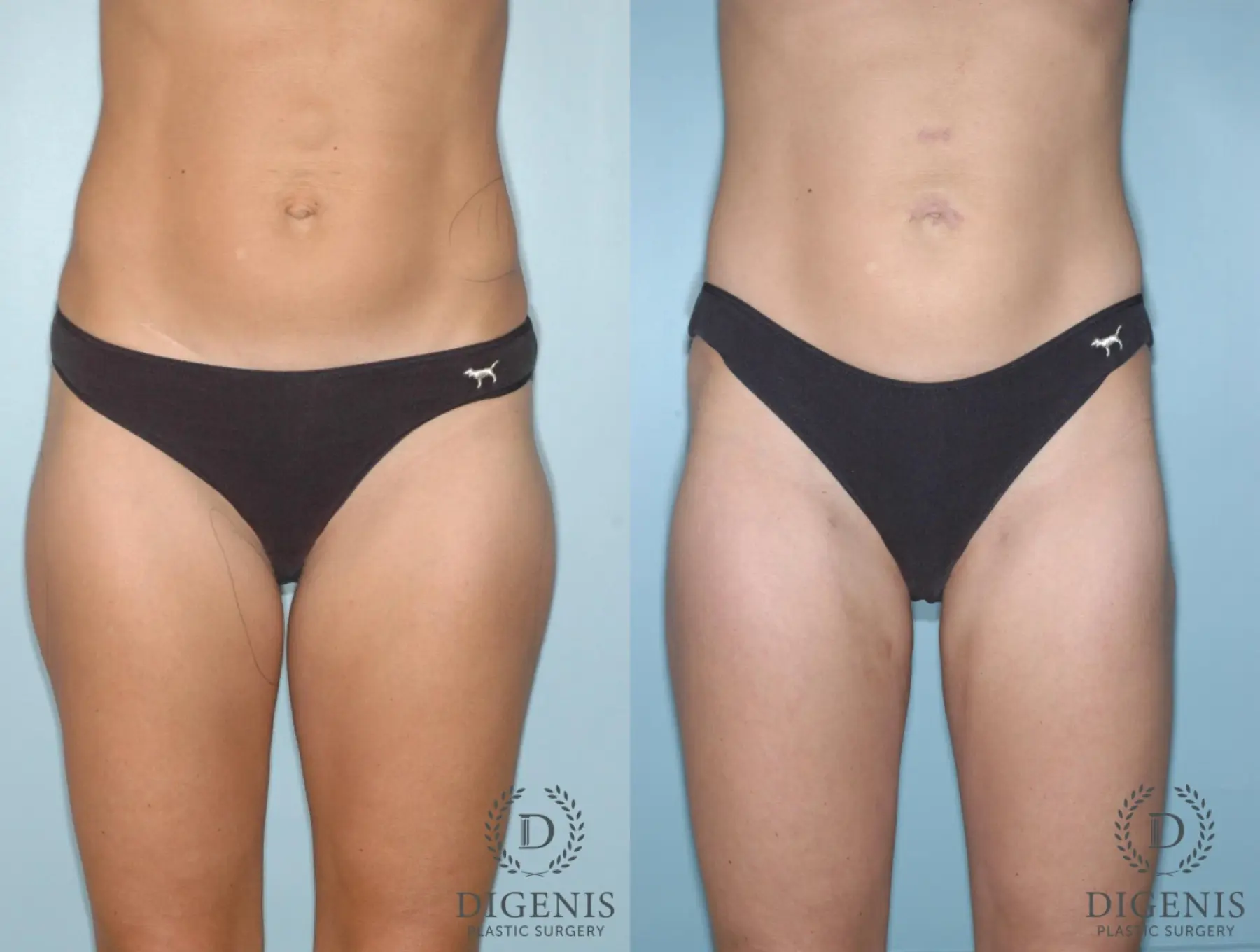 Liposuction: Patient 6 - Before and After  