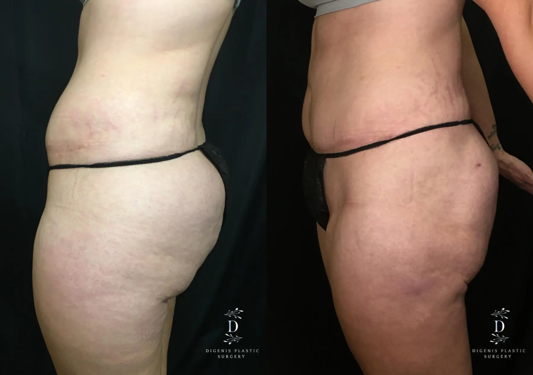 Liposuction: Patient 10 - Before and After 5
