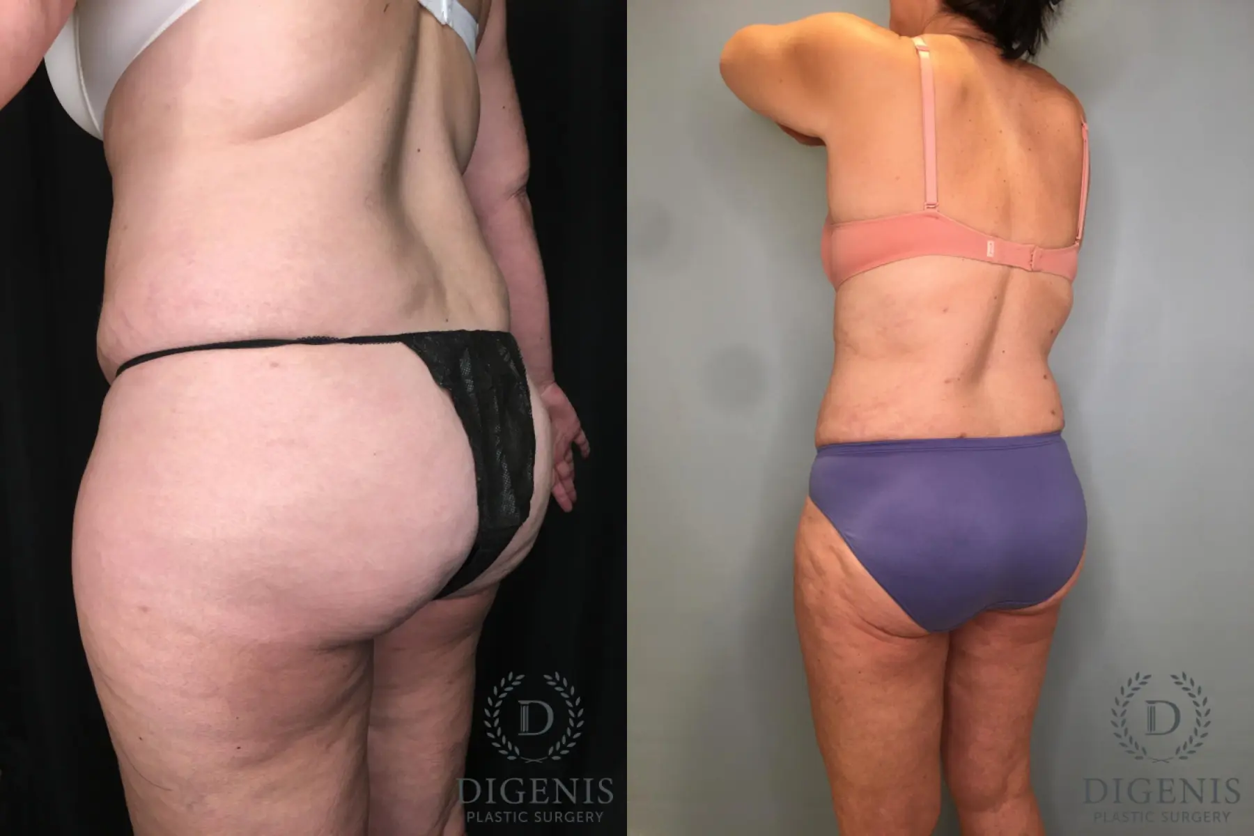 Liposuction: Patient 11 - Before and After 4