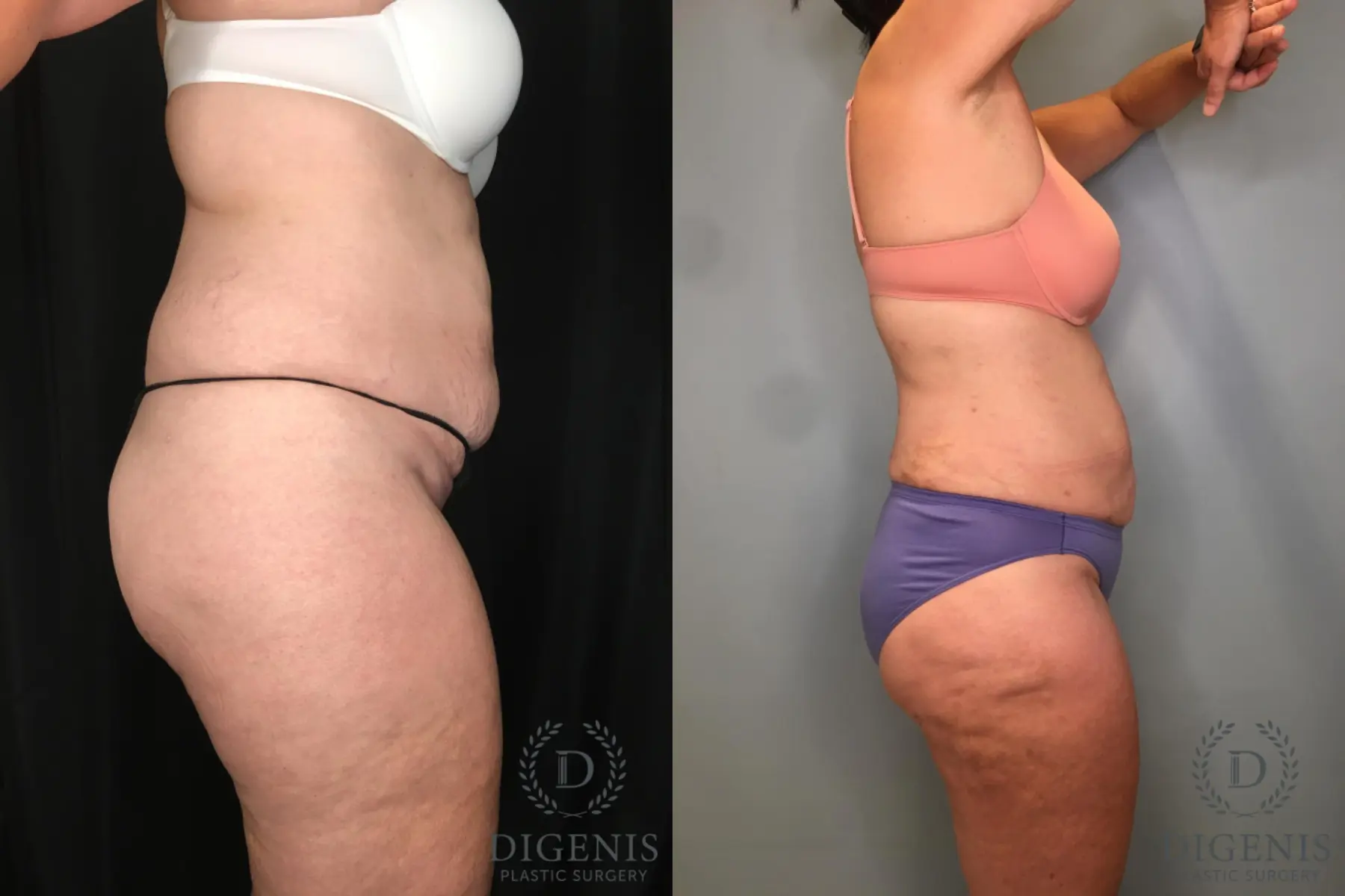 Liposuction: Patient 11 - Before and After 7