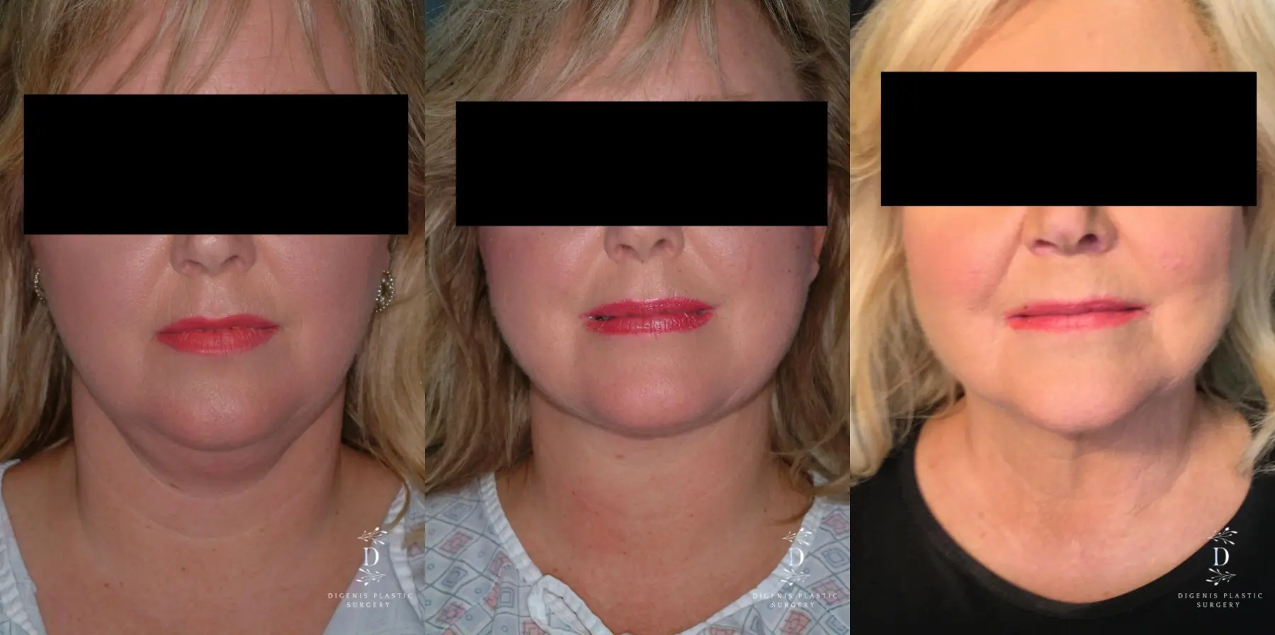 Liposuction Of The Neck: Patient 1 - Before and After  