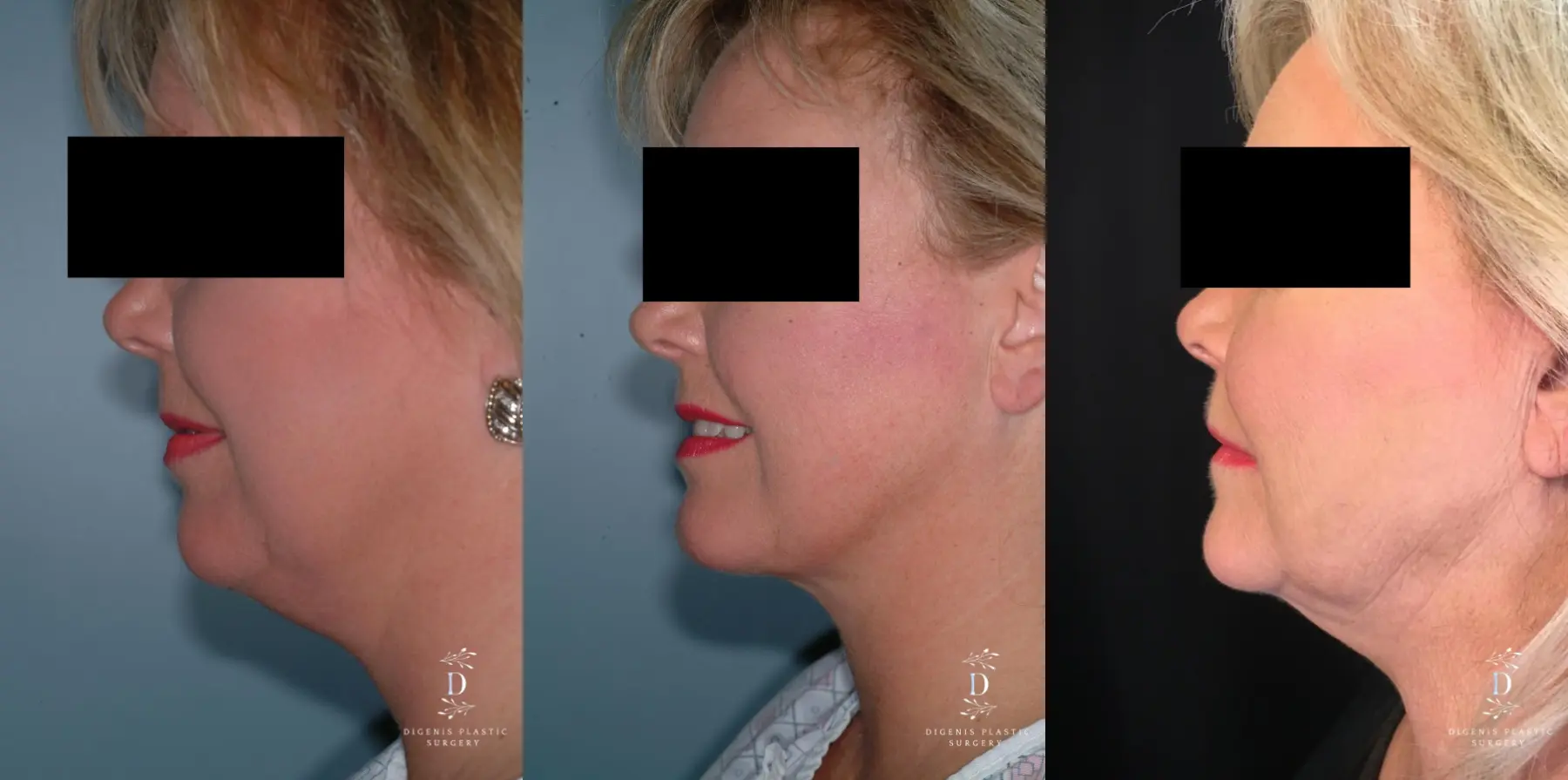 Liposuction Of The Neck: Patient 1 - Before and After 3