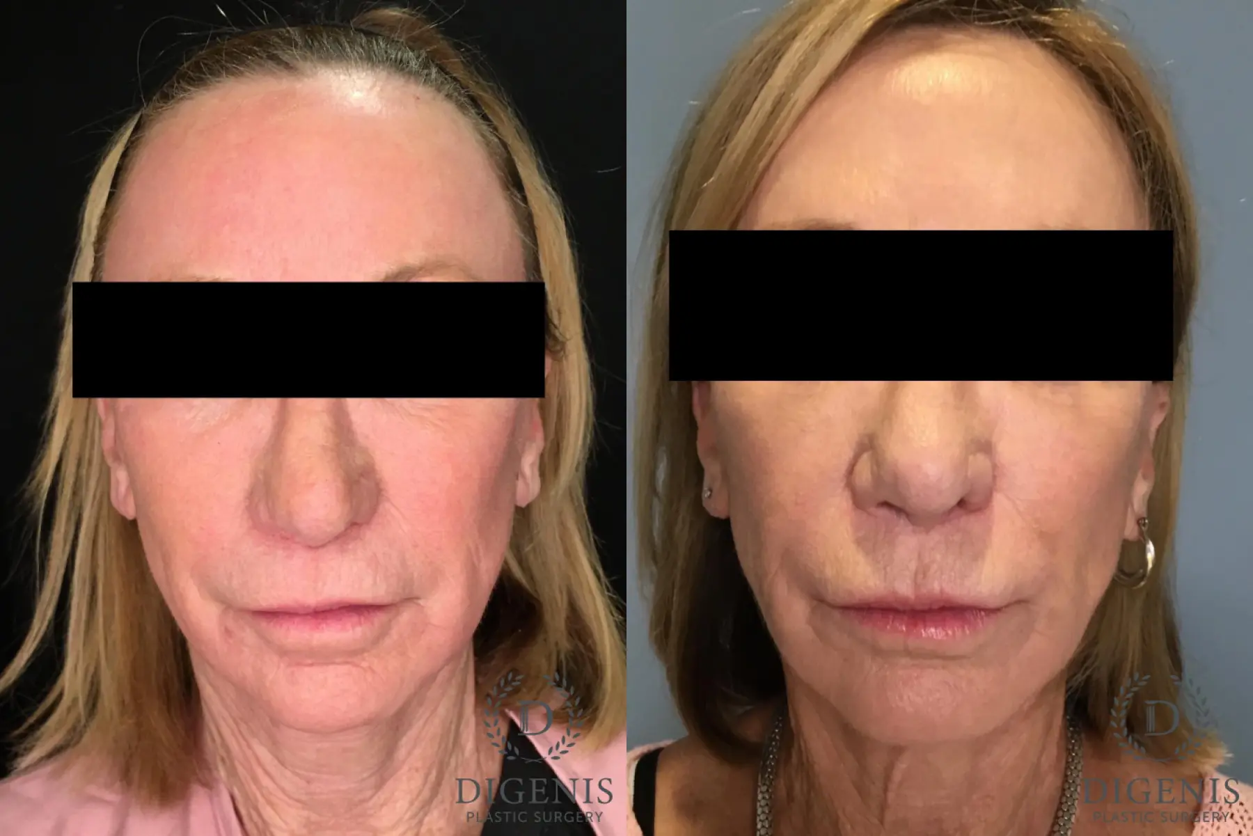 Liposuction Of The Neck: Patient 2 - Before and After  