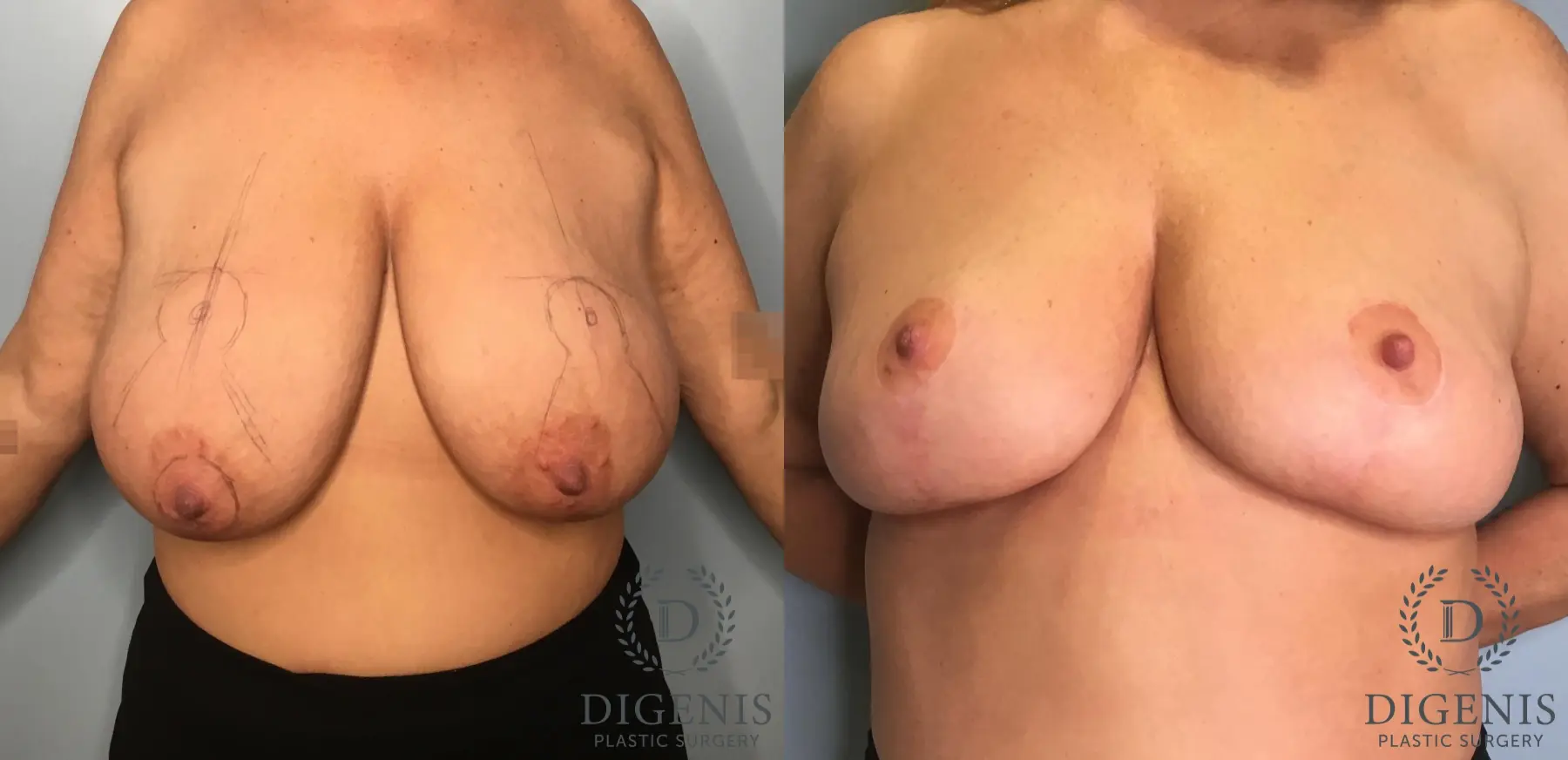Mastopexy: Patient 20 - Before and After  
