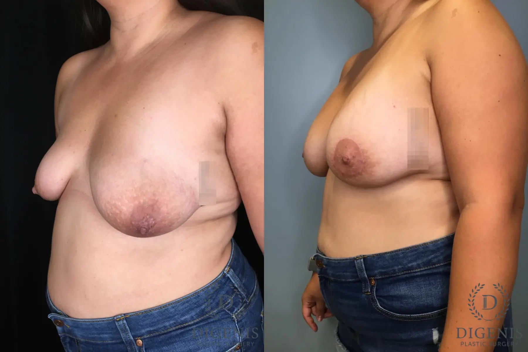 Mastopexy: Patient 3 - Before and After 2