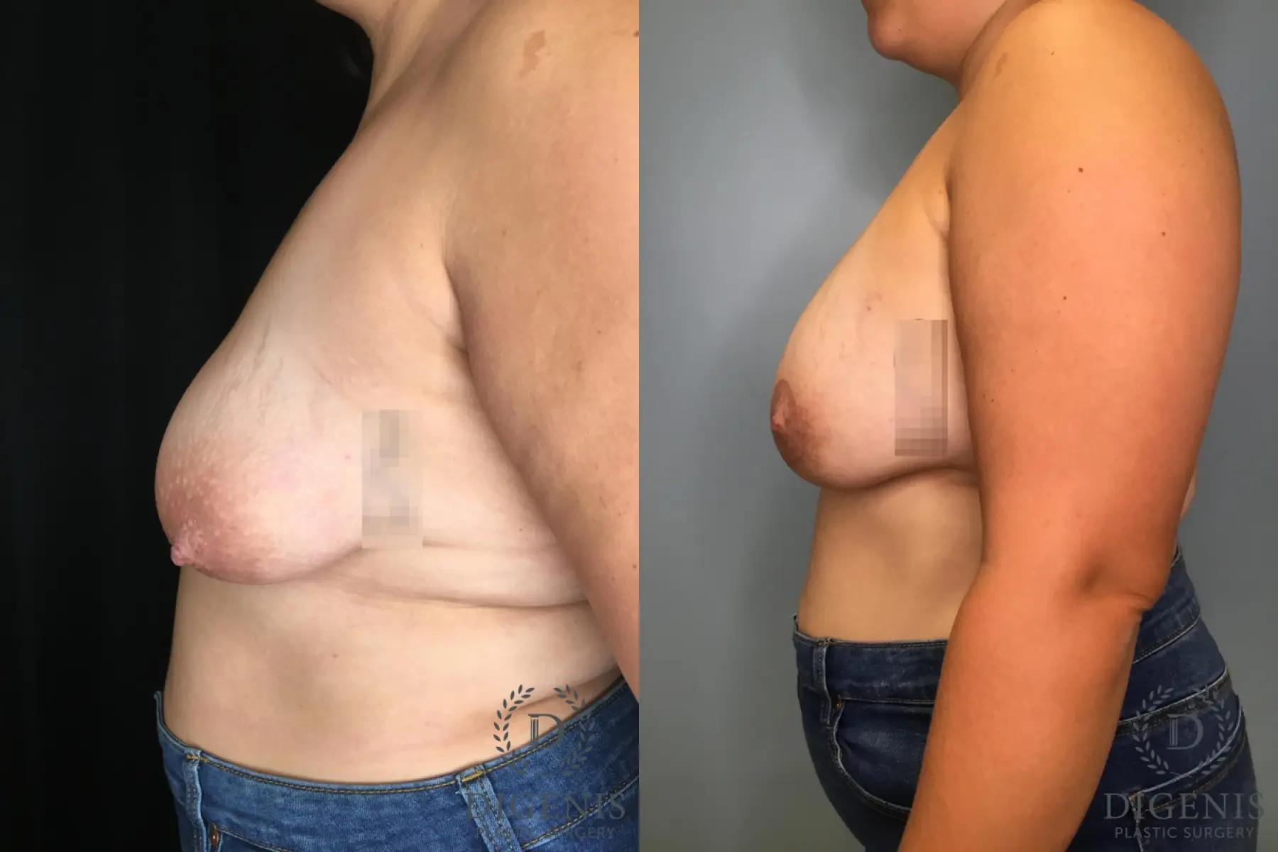 Mastopexy: Patient 3 - Before and After 3