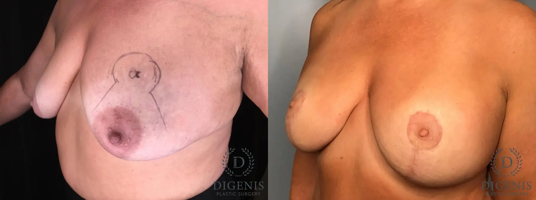 Mastopexy: Patient 2 - Before and After 2