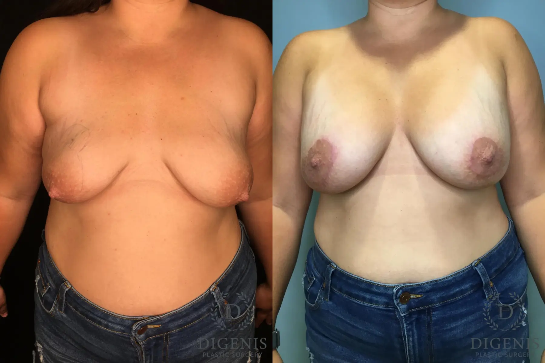 Mastopexy: Patient 3 - Before and After  