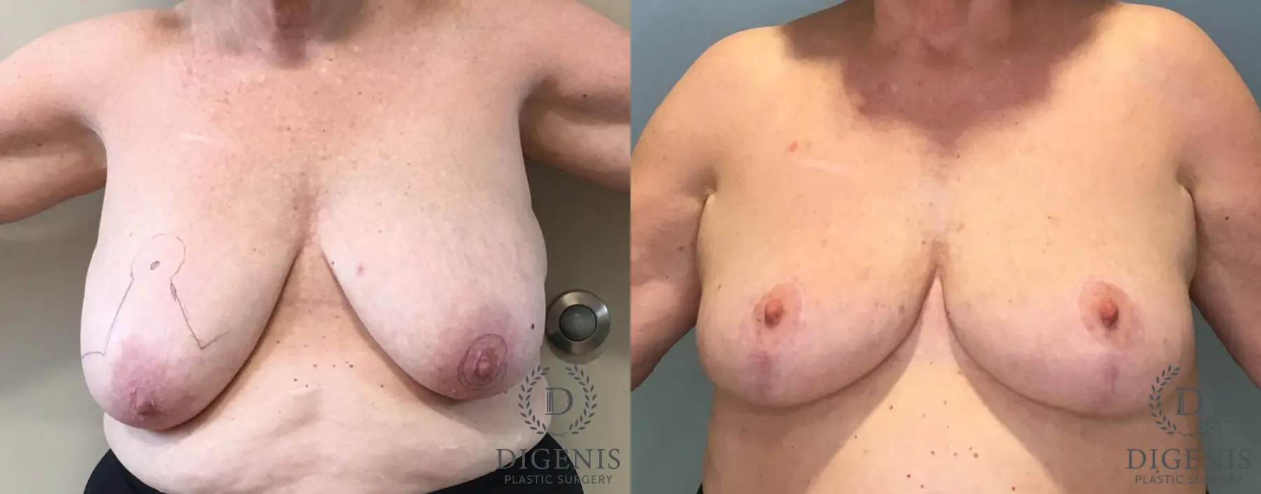 Mastopexy: Patient 11 - Before and After  