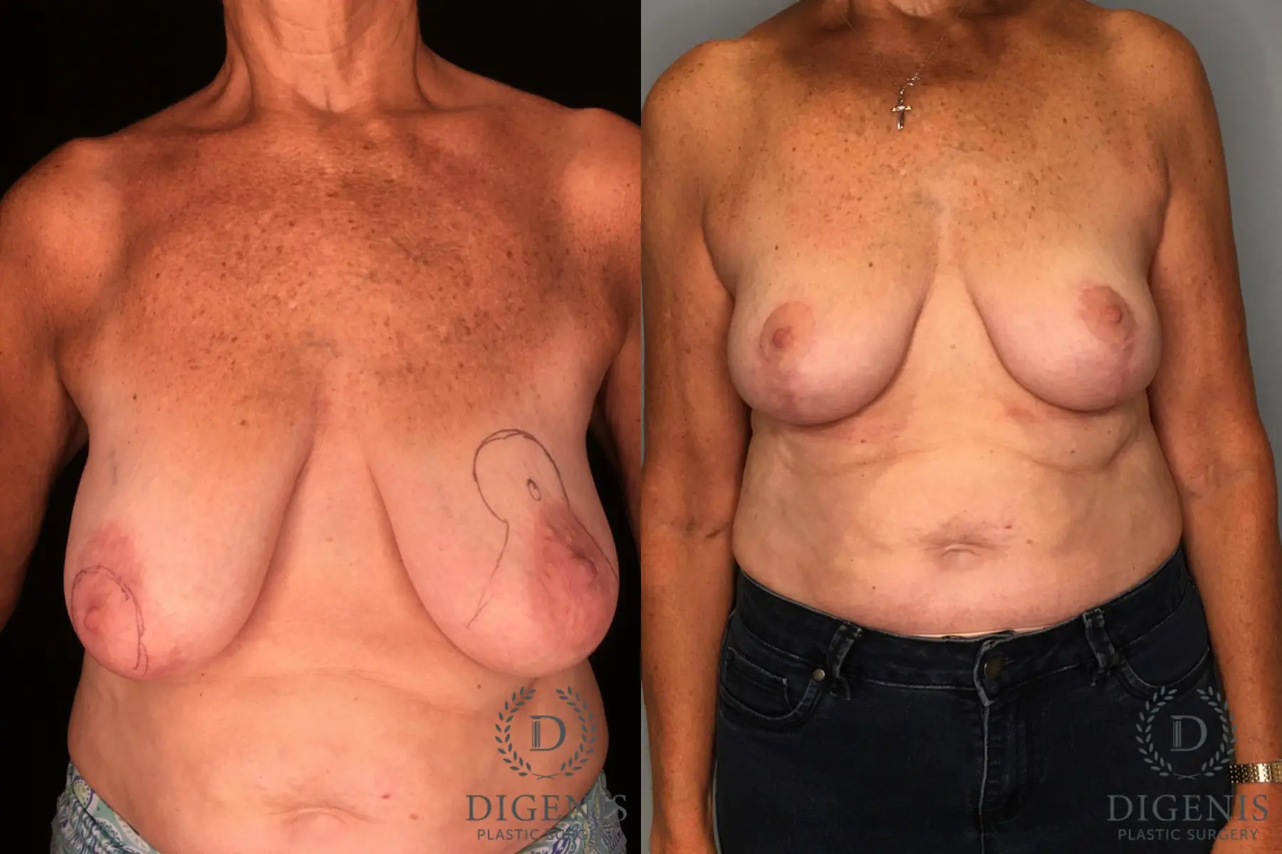 Mastopexy: Patient 1 - Before and After  