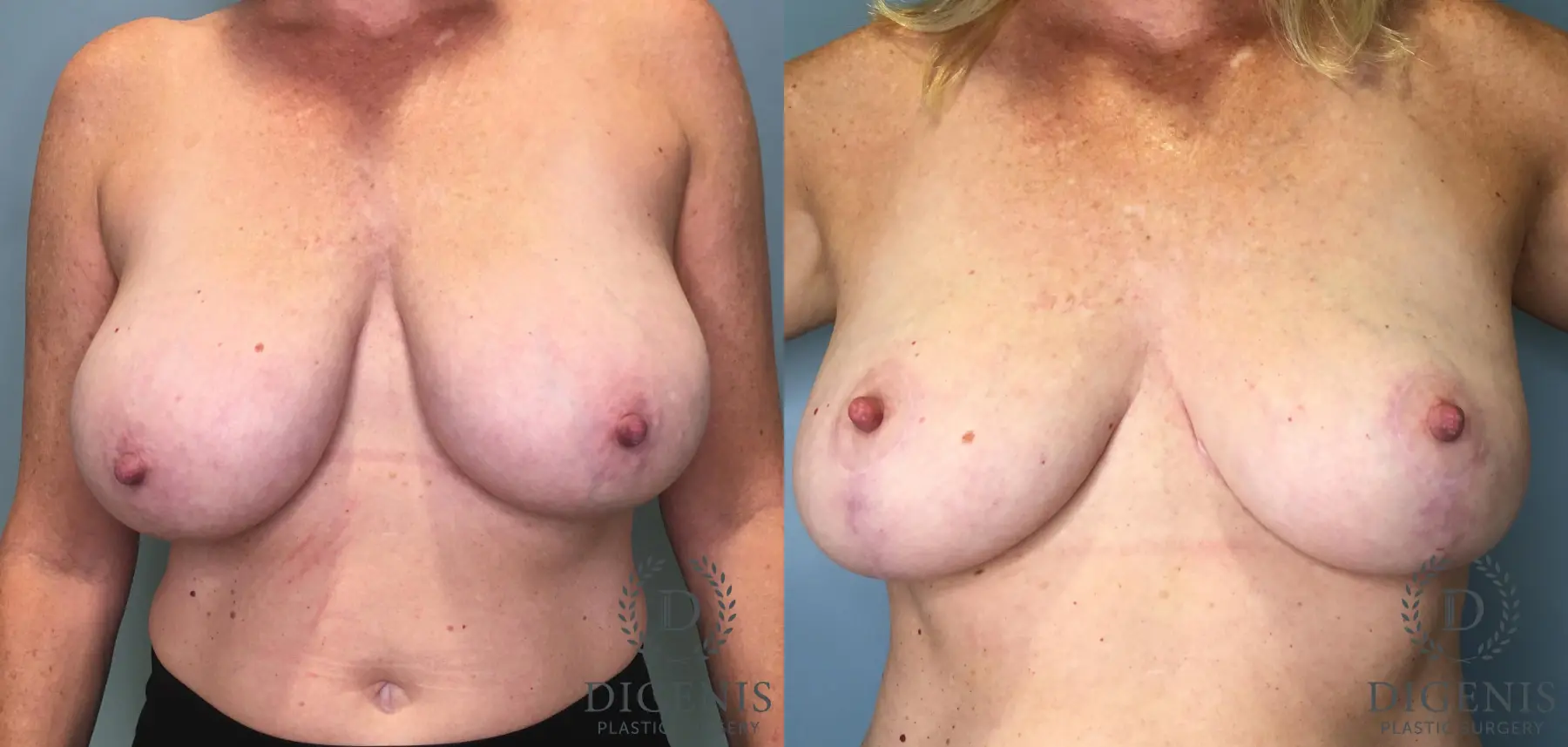 Mastopexy: Patient 14 - Before and After  