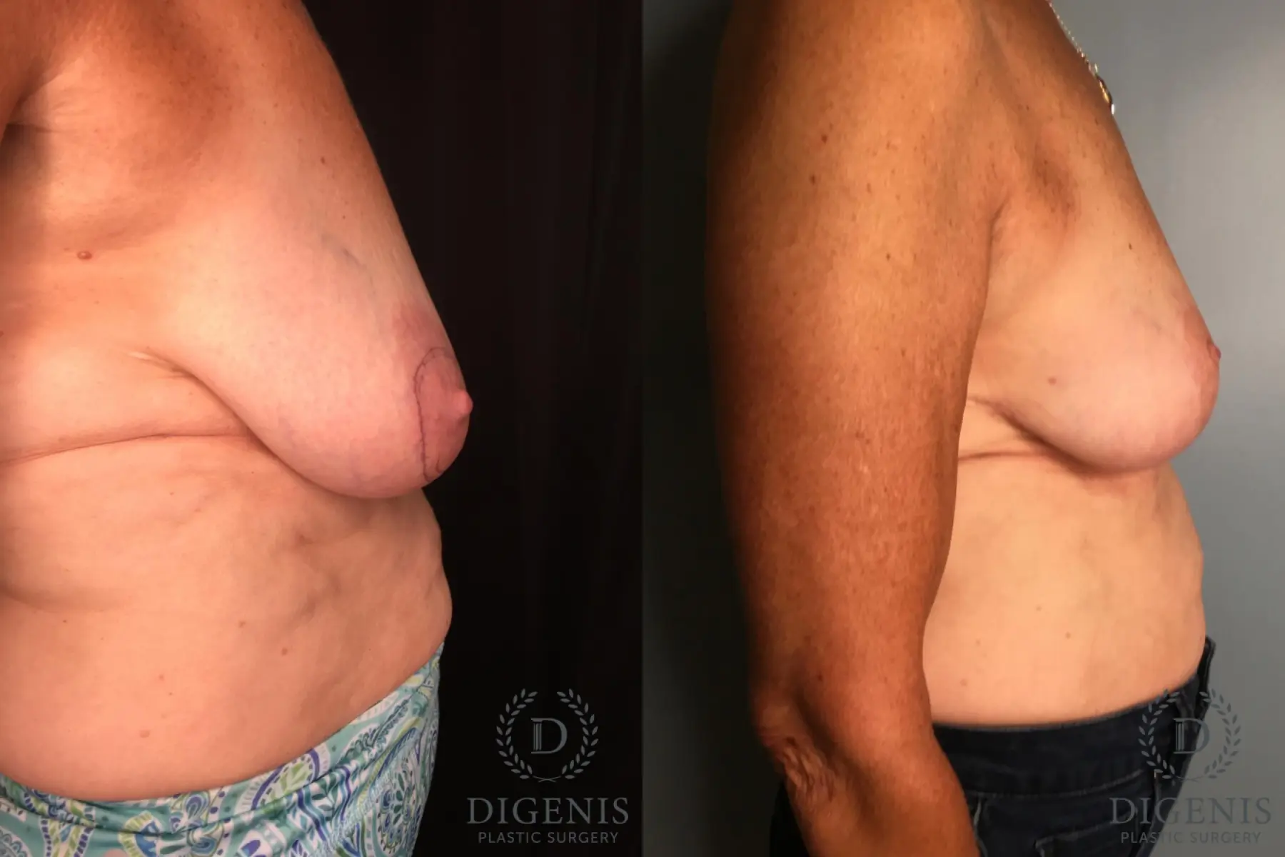 Mastopexy: Patient 1 - Before and After 3
