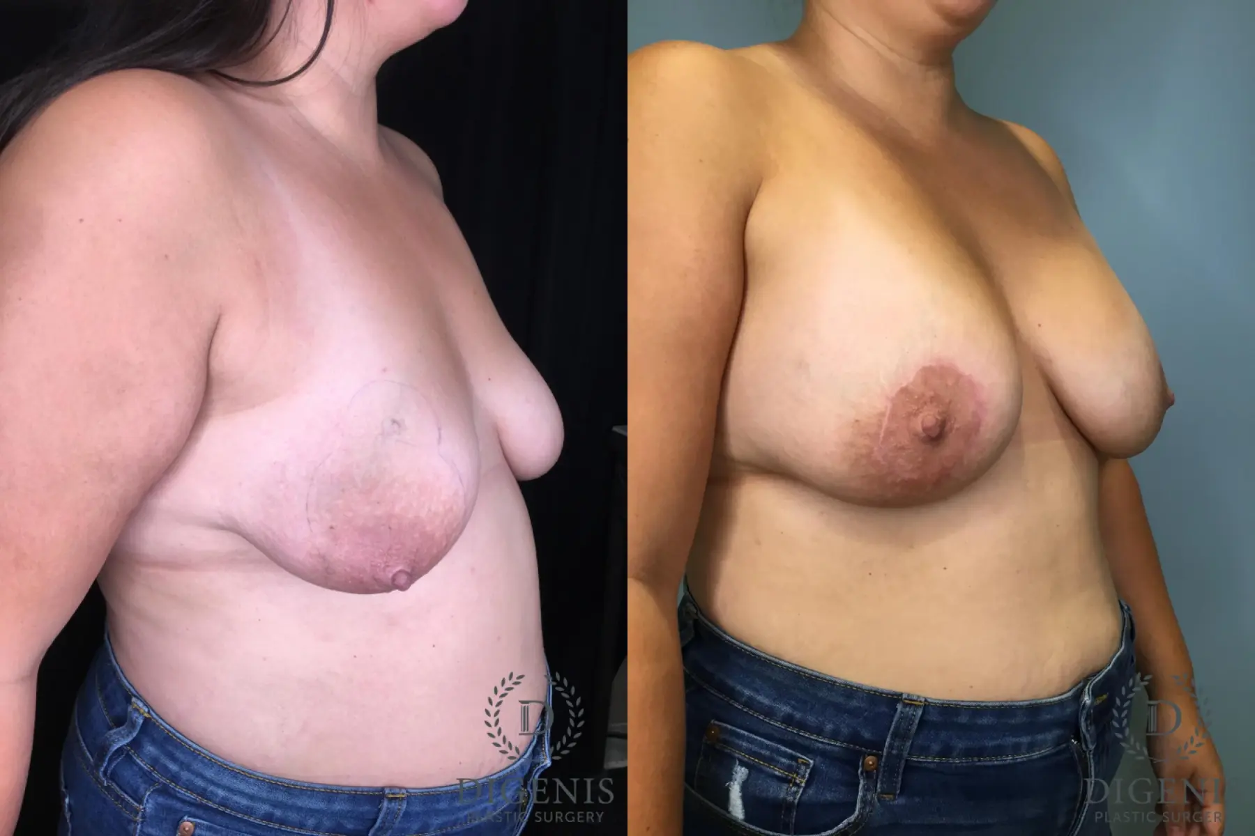 Mastopexy: Patient 3 - Before and After 4