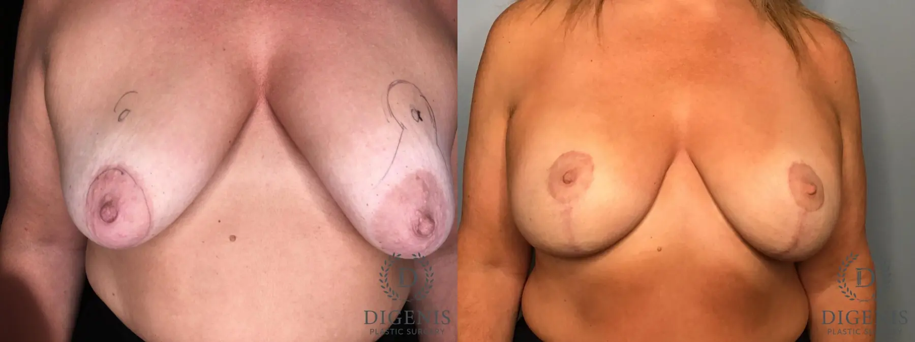 Mastopexy: Patient 2 - Before and After 1