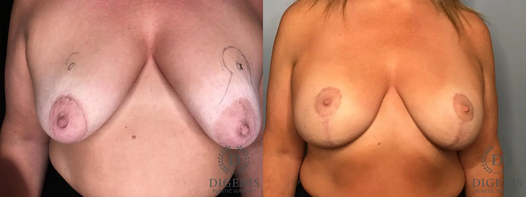 Mastopexy: Patient 2 - Before and After  