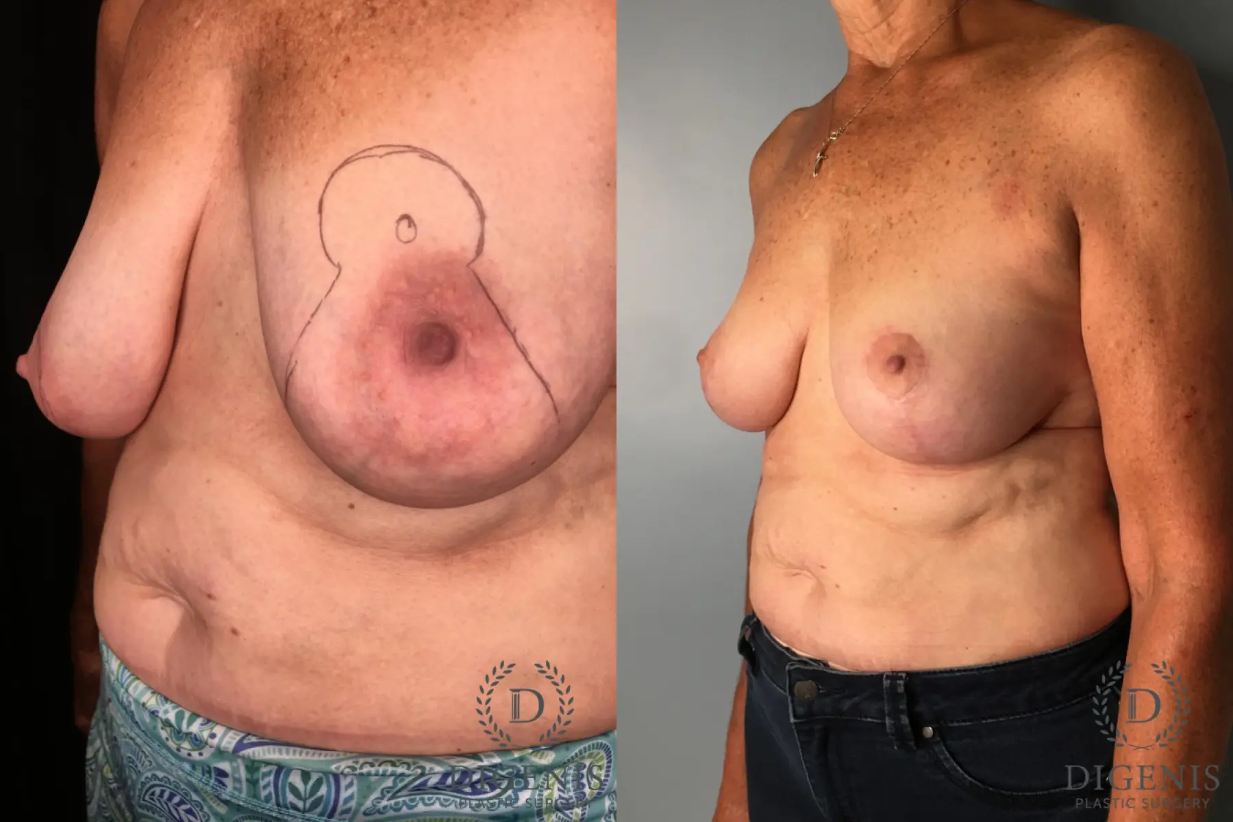 Mastopexy: Patient 1 - Before and After 4