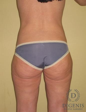 Liposuction: Patient 1 - After 2
