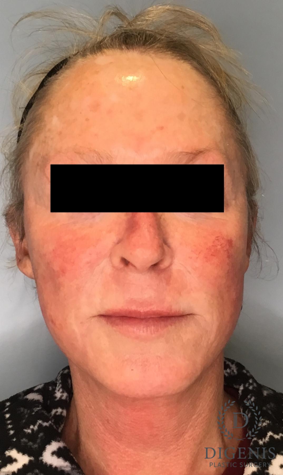 Facelift: Patient 1 - After  