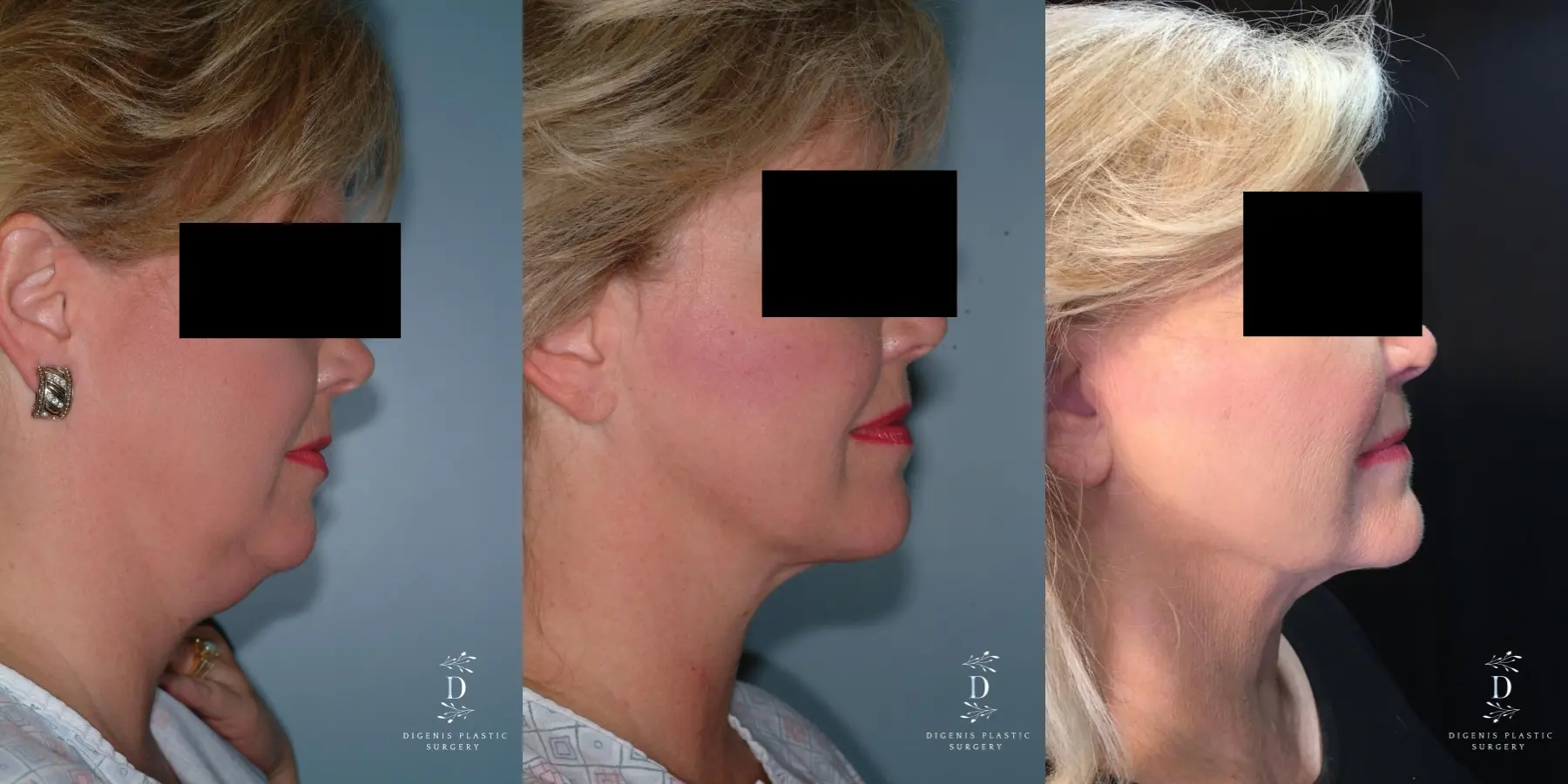 Neck Lift: Patient 2 - Before and After 2