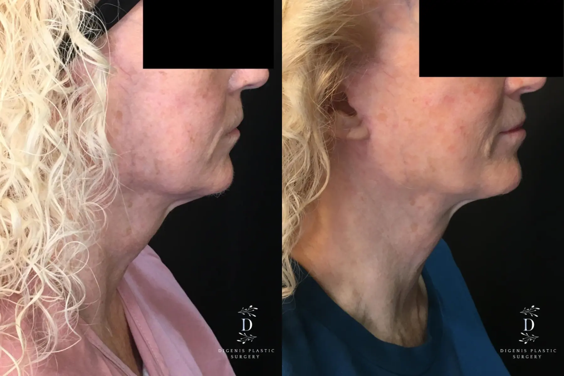 Neck Lift: Patient 1 - Before and After 3