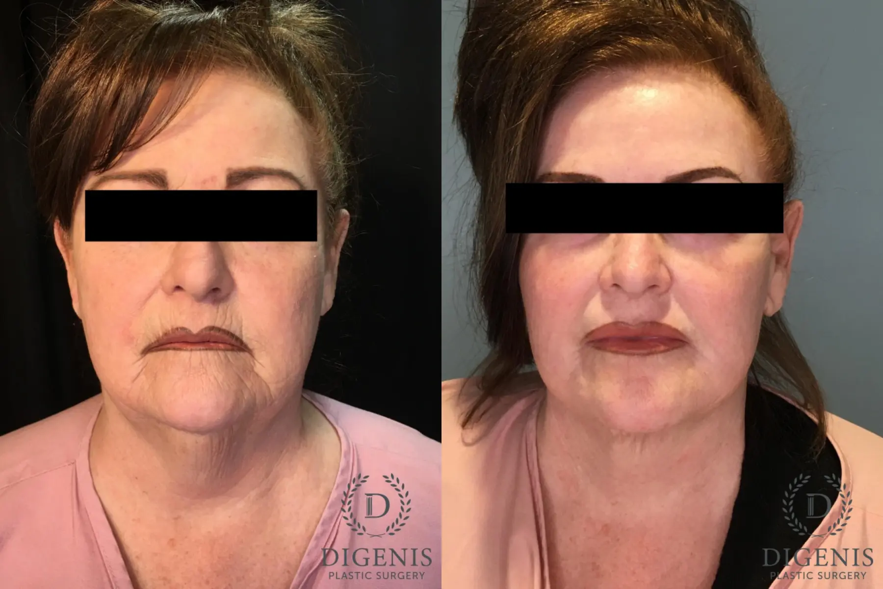 Neck Lift: Patient 2 - Before and After  