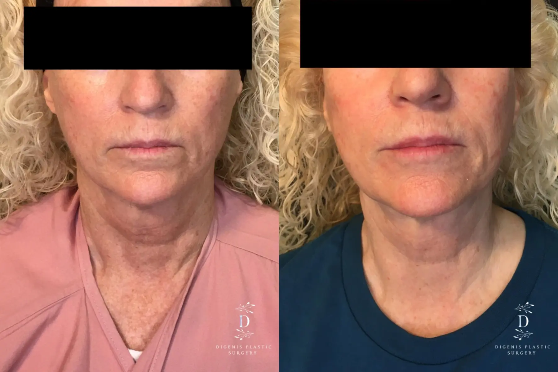 Neck Lift: Patient 1 - Before and After  